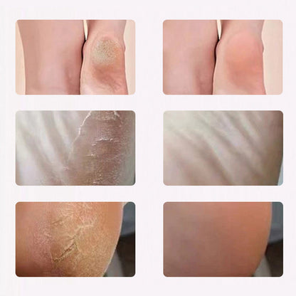 🔥Time-limited Special Price ￡12.99!!🦶Electric Feet Callus Remover
